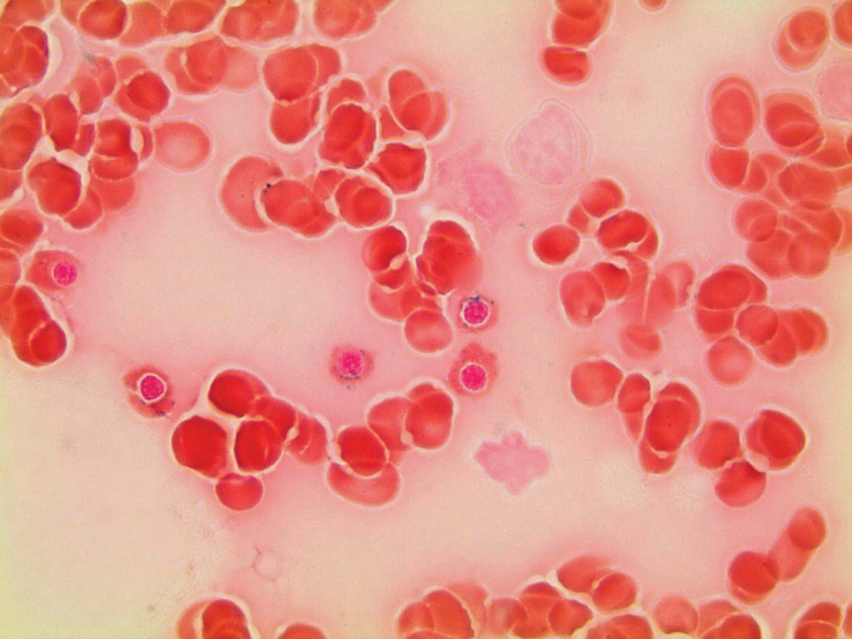 Ring sideroblasts 1000x